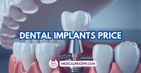 dental implants cost in the philippines|Philippines Dental Implants: Cost of Dental Work and Where to .